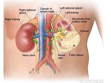 Pembrolizumab, a type of immunotherapy known as a PD-1 inhibitor<br>