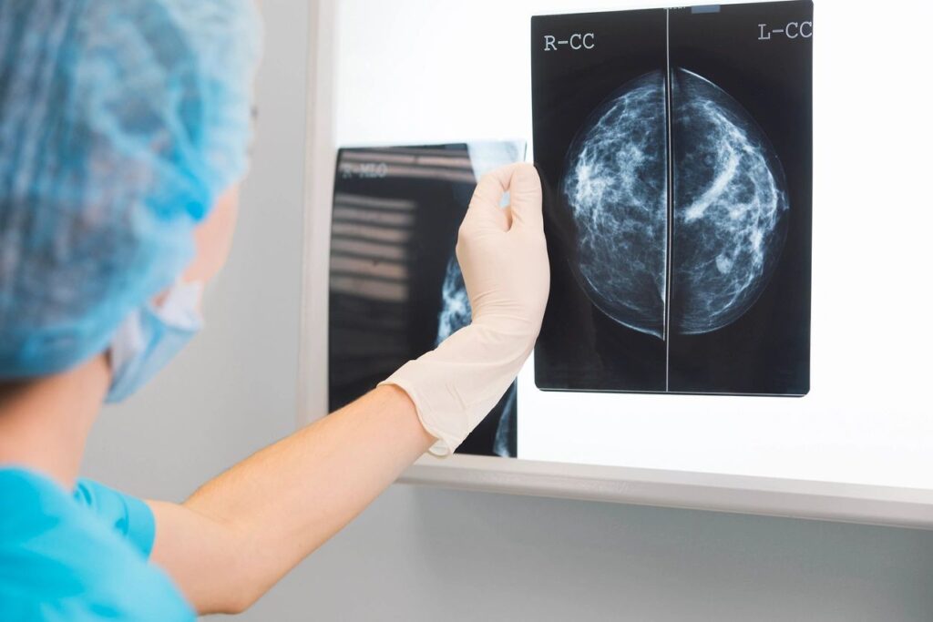 Optimizing Breast Cancer Treatment: Surgery, RT, and cosmetic