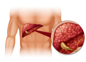 Transition to Personalized Oncology in Liver Cancer