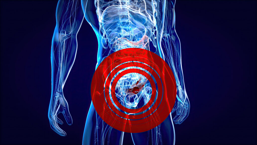 Sensitivity of a blood ctDNA-based multimodal test for the detection of advanced colorectal neoplasms